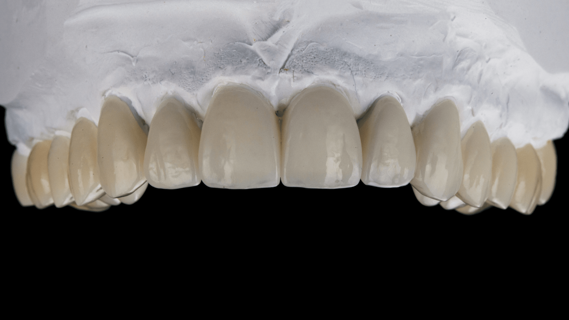 dental veeners (2) (1)